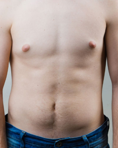 Gynecomastia Surgery in Vijayawada