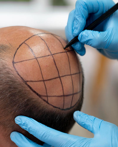 Hair Transplantation in Vijayawada