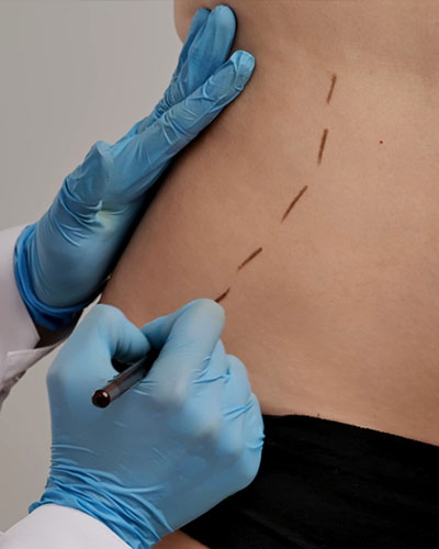 Liposuction Surgery in Vijayawada