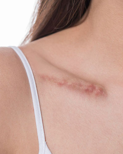 Scar Removal Treatment in Vijayawada